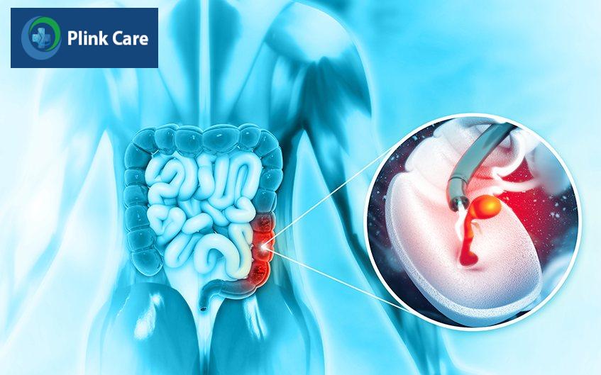 cắt bỏ polyp đại tràng