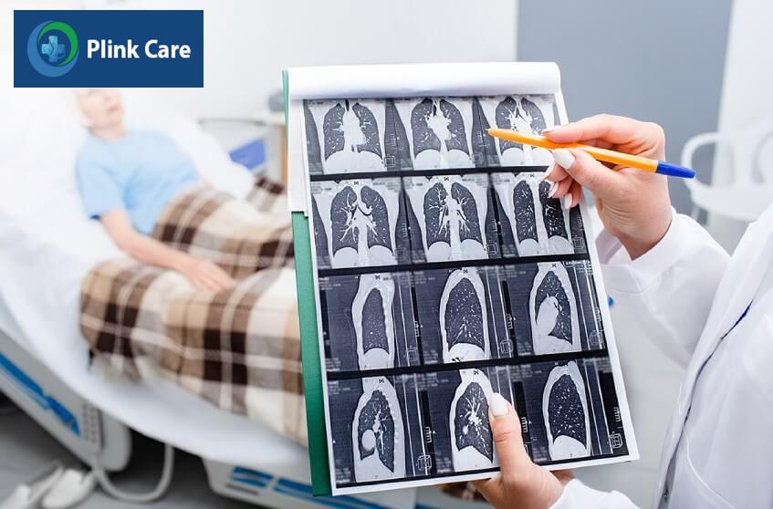 chẩn đoán ung thư phổi không tế bào nhỏ giai đoạn 1