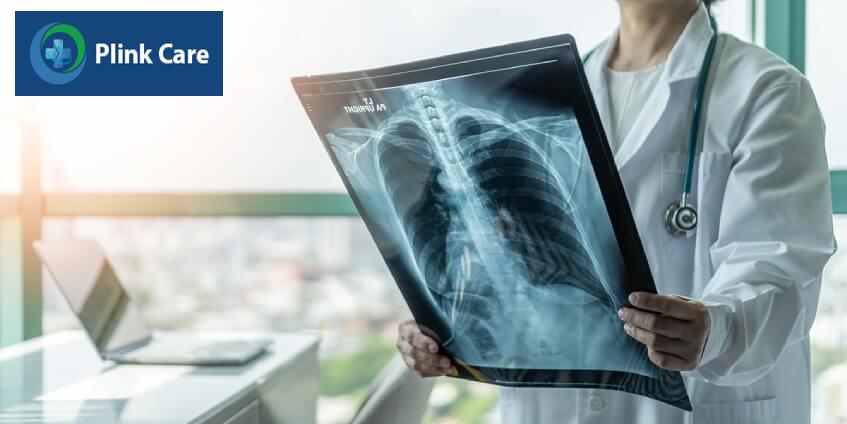 chẩn đoán ung thư phổi không tế bào nhỏ giai đoạn 2