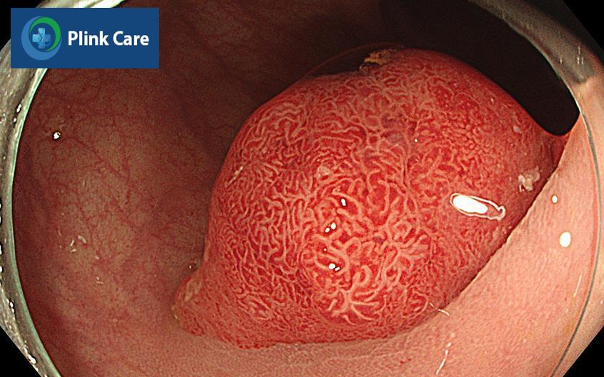 có nên cắt polyp đại tràng