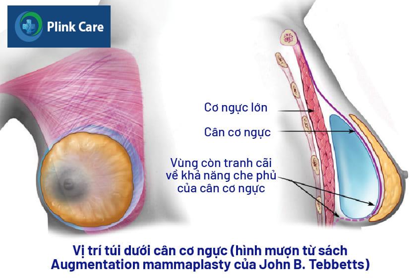 Đặt túi ngực dưới cân