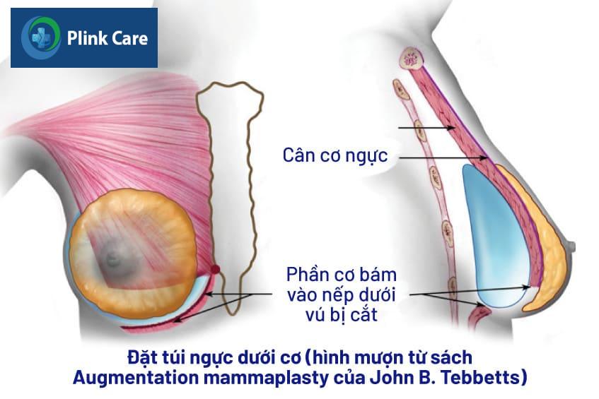 Các vị trí đặt túi ngực dưới cơ