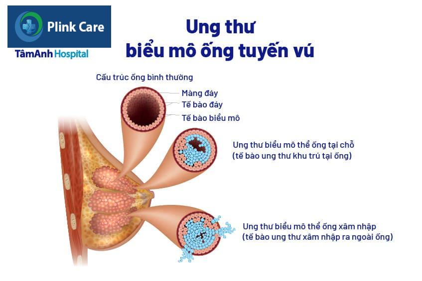 Dấu hiệu ung thư biểu mô ống tuyến vú tại chỗ (DCIS)