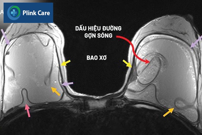 dấu hiệu vỡ túi ngực