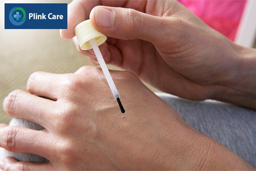 điều trị mụn cóc tại nhà bằng thuốc bôi