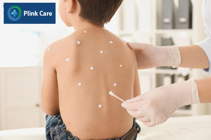 Dùng thuốc bôi trị thủy đậu