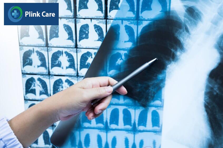 hình ảnh ung thư phổi không tế bào nhỏ giai đoạn 2