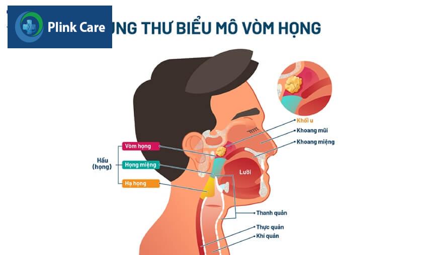 hình ảnh ung thư vòm họng giai đoạn 0