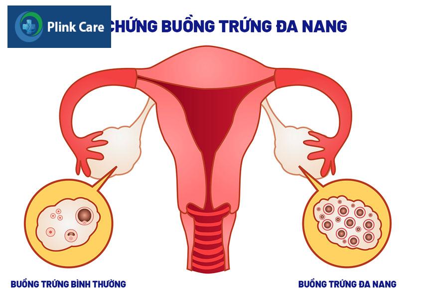 hội chứng pcos