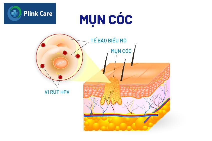 mụn cóc phẳng có lây không