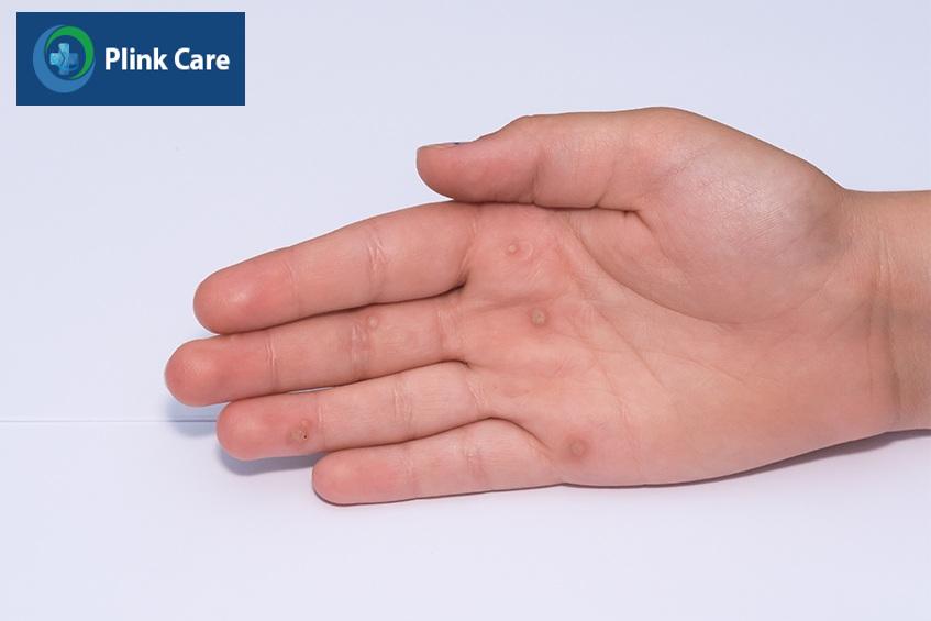 mụn cóc phẳng trông như thế nào