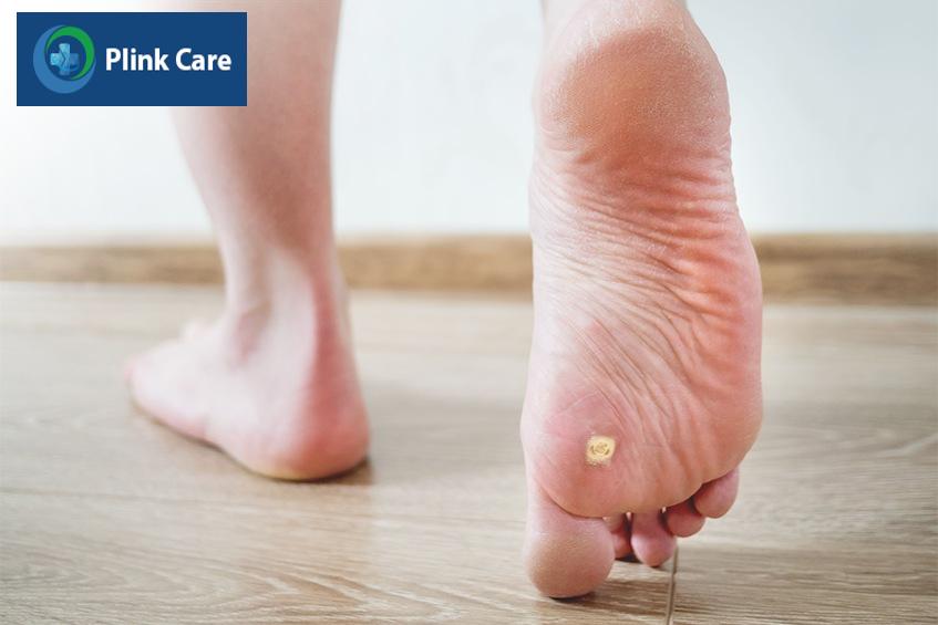 nguyên nhân bị mụn cóc ở chân