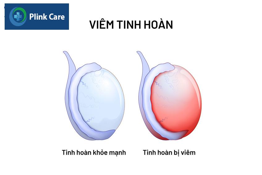 nguyên nhân do viêm tinh hoàn