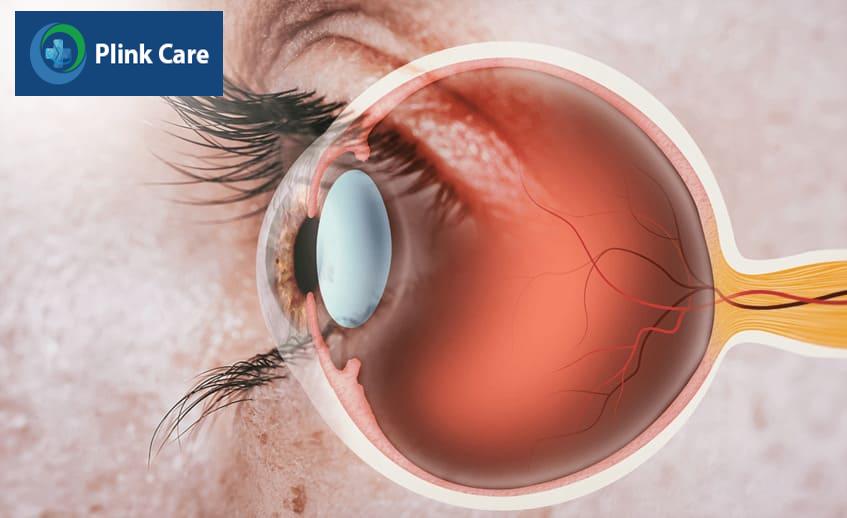Nguyên nhân gây bệnh viêm kết mạc