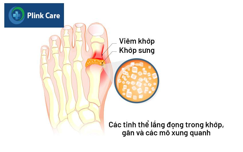 nguyên nhân gây cơn gout cấp
