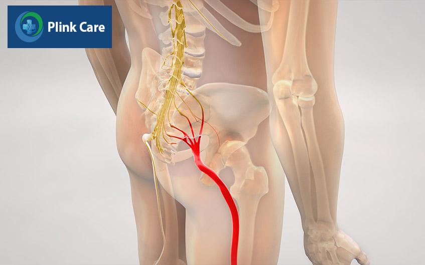 nguyên nhân gây đau dây thần kinh tọa