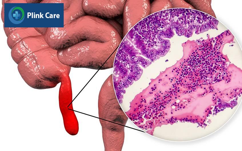 nguyên nhân dẫn đến viêm ruột thừa cấp tính