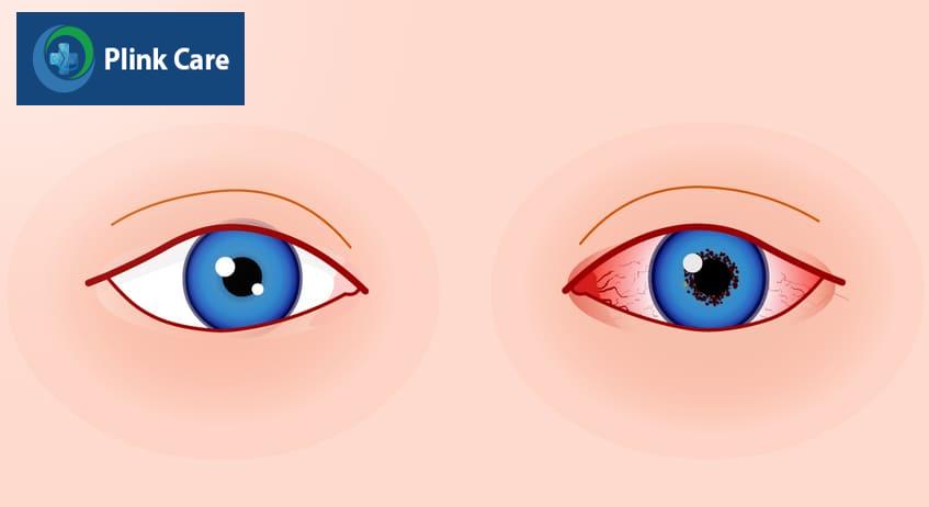 Nguyên nhân viêm mống mắt thể mi