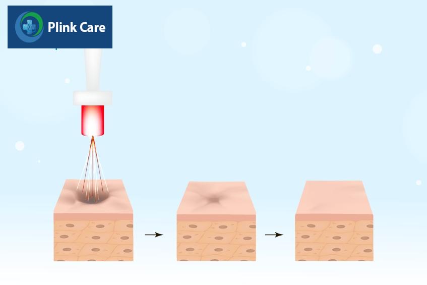 nguyên tắc hoạt động của laser pico