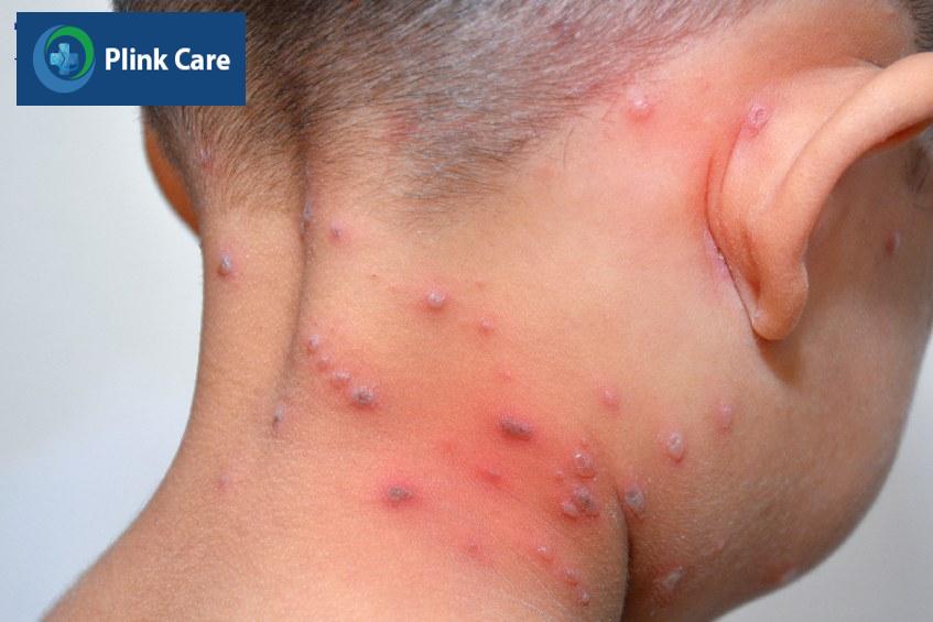 Nốt thủy đậu có thể mọc ở nhiều vị trí trên cơ thể