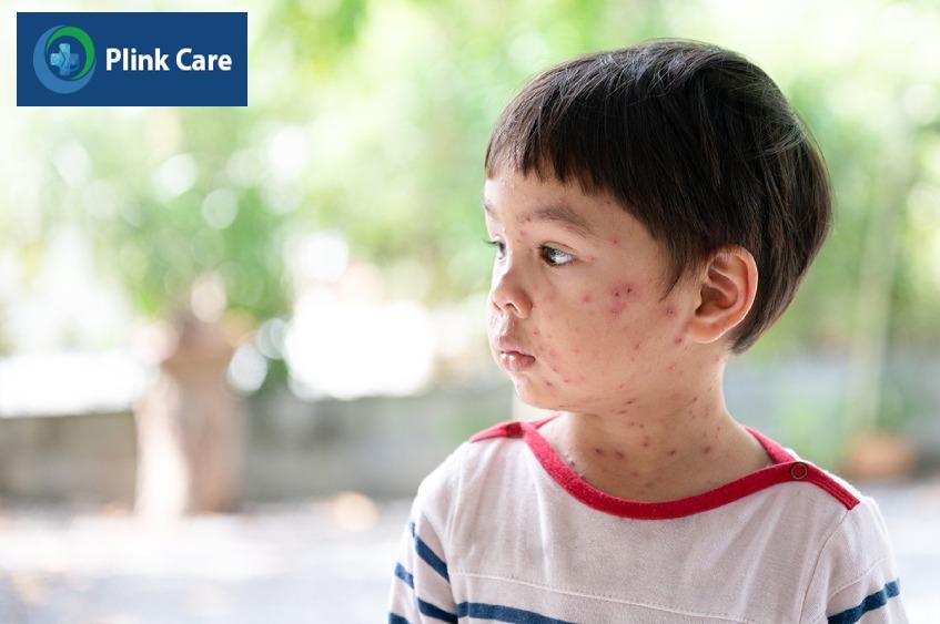 Nốt thủy đậu lan rộng ở vùng cổ và mặt của trẻ