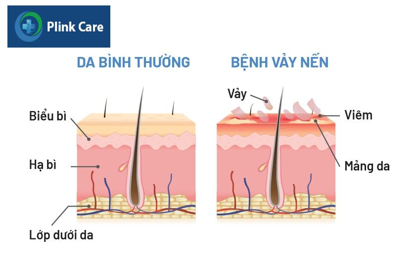 phân biệt da bình thường và da bị vảy nến