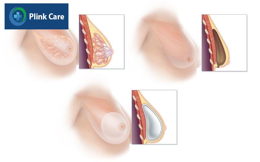 tái tạo túi cơ ngực