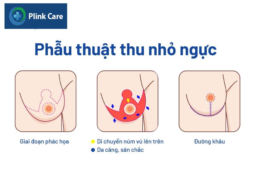 Phương pháp phẫu thuật thu nhỏ ngực