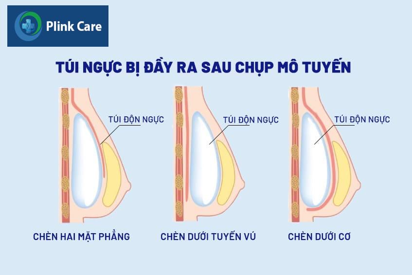 Phương pháp tầm soát ung thư vú
