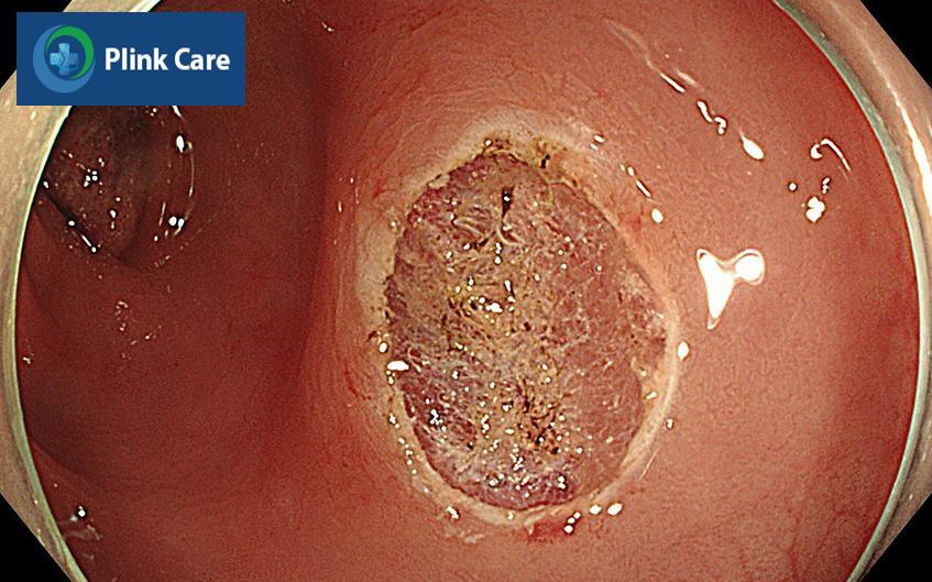 polyp đại tràng có nên cắt không