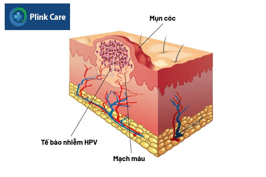 quá trình hình thành mụn cóc