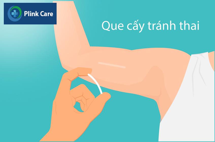 que tránh thai được cấy dưới da cánh tay