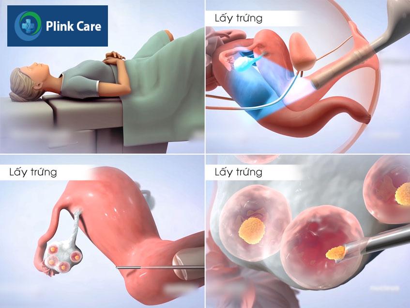 quy trình lấy trứng