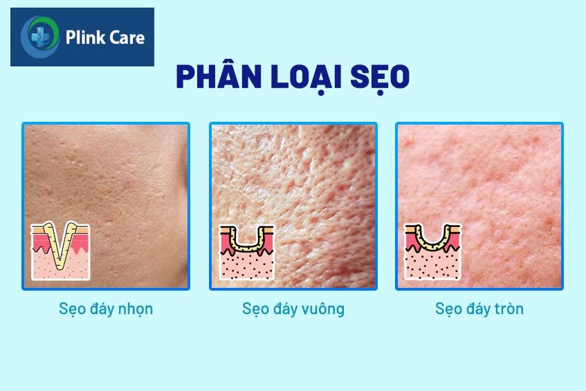 phân loại sẹo rỗ