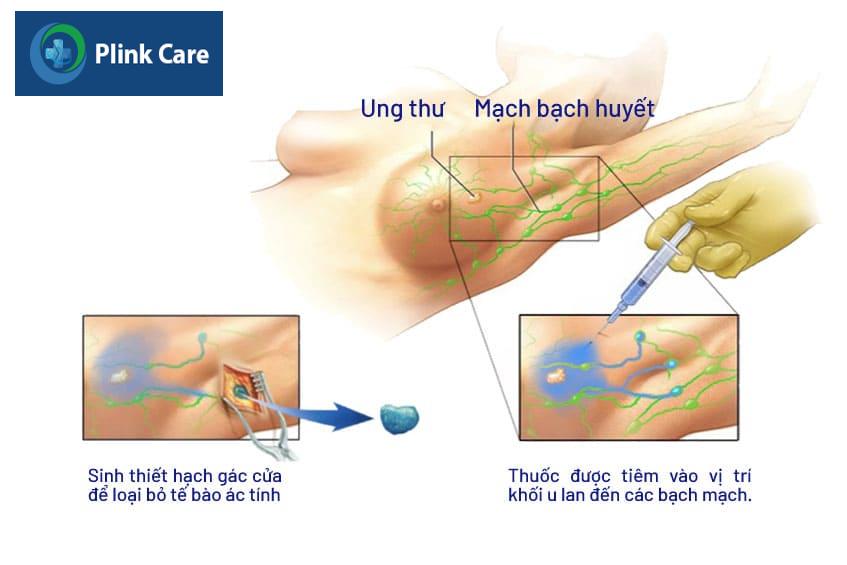 Sinh thiết hạch gác cửa bằng xanh methylen