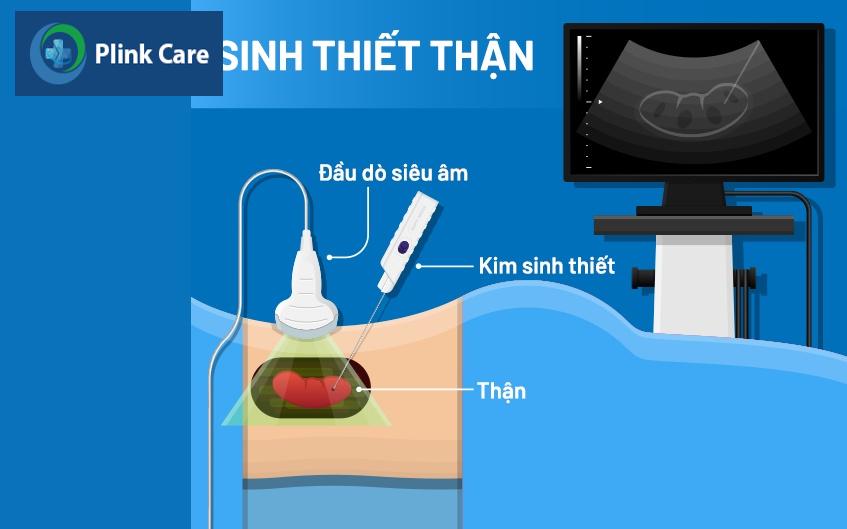 sinh thiết thận