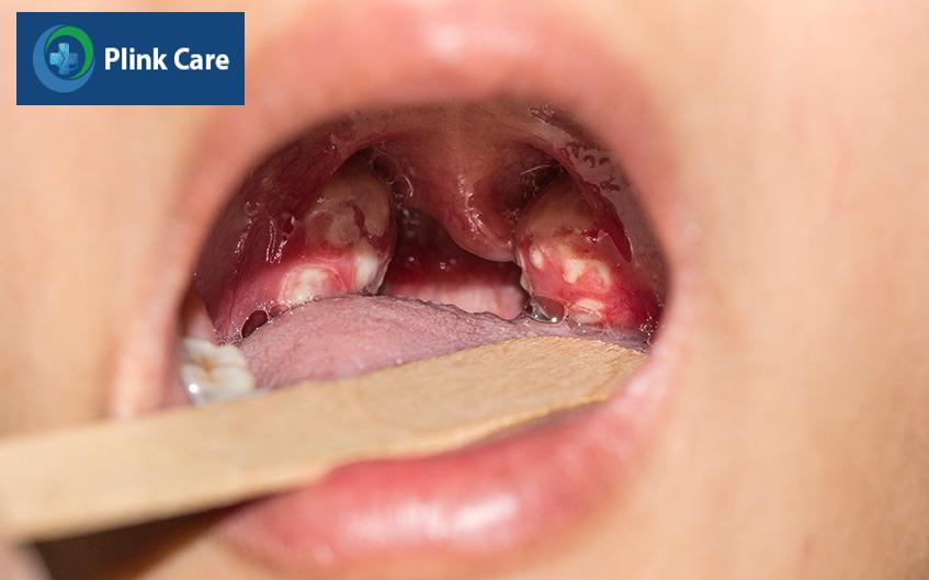 sự phát triển bệnh lậu ở trẻ em