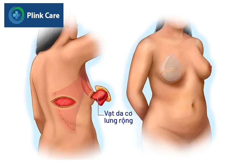 Tái tạo vú bằng vạt da cơ lưng rộng