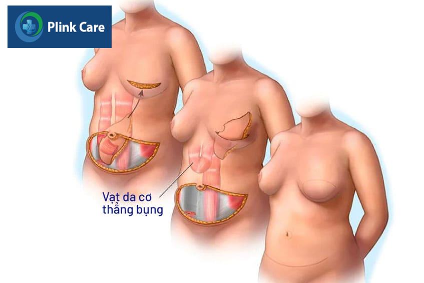Tái tạo vú bằng vạt da cơ thẳng bụng