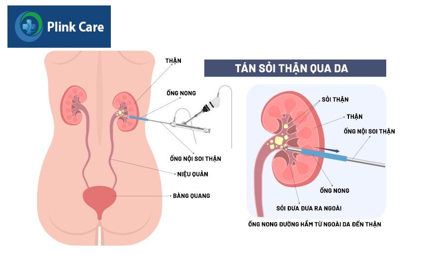 tán sỏi thận qua da