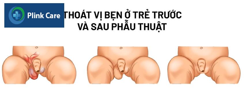 Thoát vị bẹn ở trẻ trước và sau phẫu thuật
