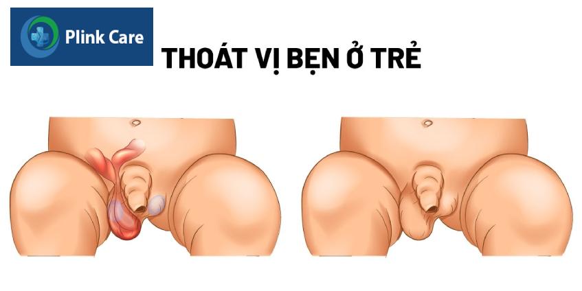 Thoát vị bẹn ở trẻ