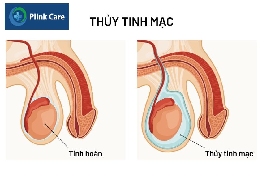 Thủy tinh mạc ở trẻ