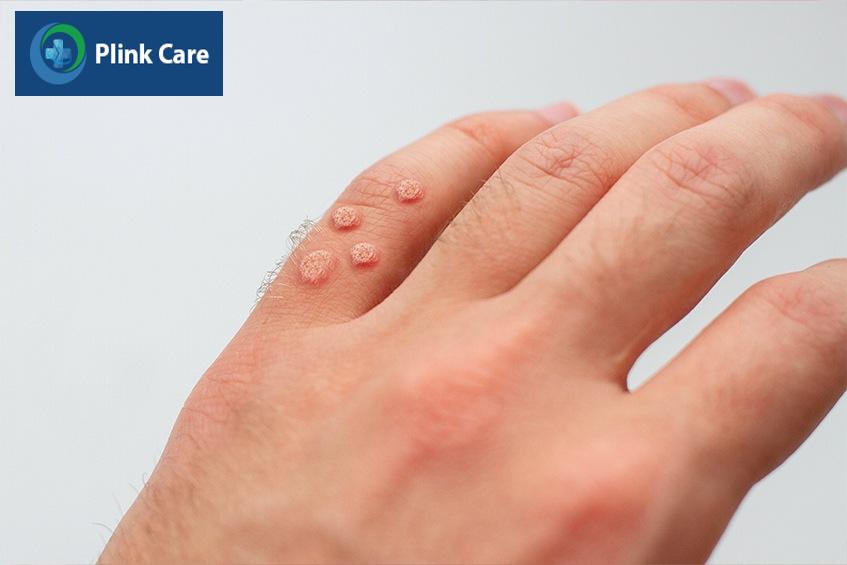 tổng quan về mụn cóc
