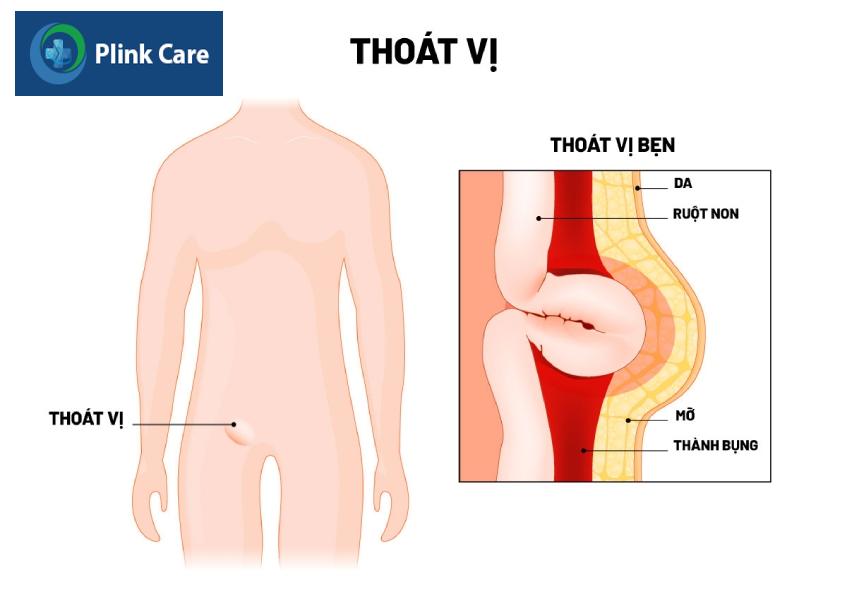 Trẻ xuất hiện một khối tròn bất thường ở vùng bẹn