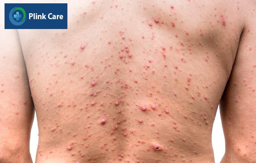 Triệu chứng điển hình của bệnh thủy đậu