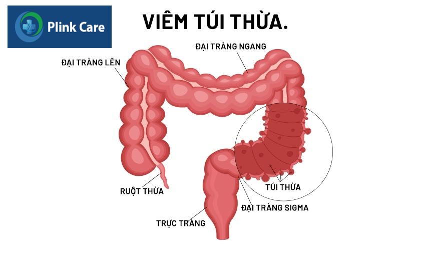 túi thừa