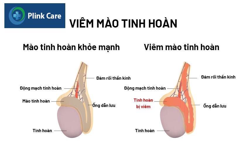 viêm mào tinh hoàn