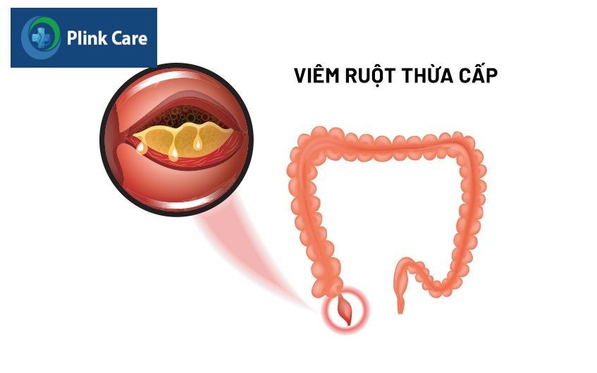 viêm ruột thừa cấp là gì