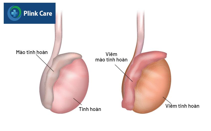 viêm tinh hoàn